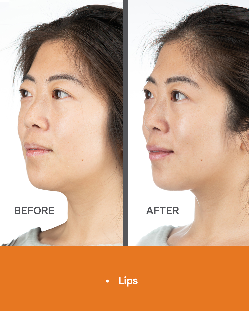 ACP MB WEB Aesthetic Medicine Before After Photos 3 20 02
