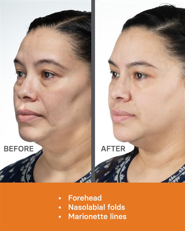 ACP MB WEB Aesthetic Medicine Before After Photos 3 20 03