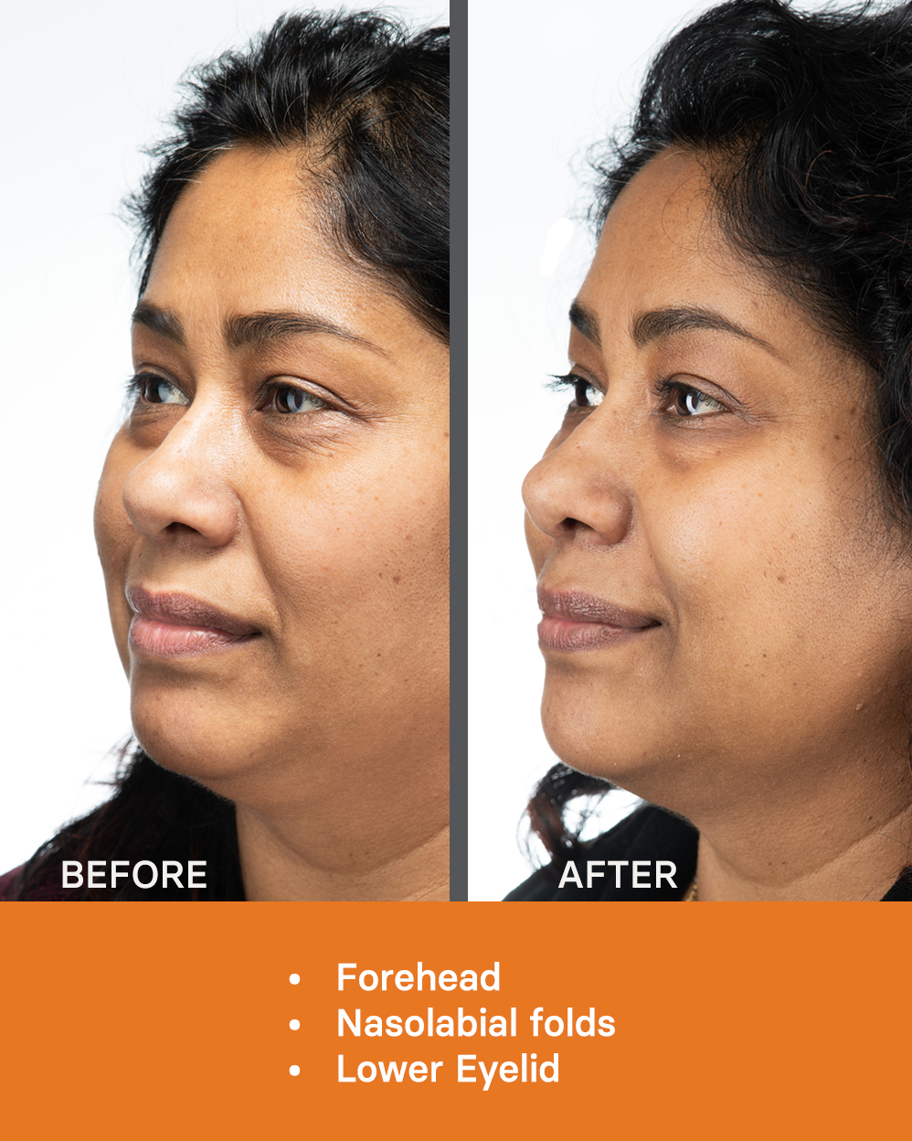 ACP MB WEB Aesthetic Medicine Before After Photos 3 20 04